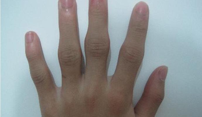 风湿两项是检查风湿还是类风湿,风湿因子是能查出风湿还是类风湿