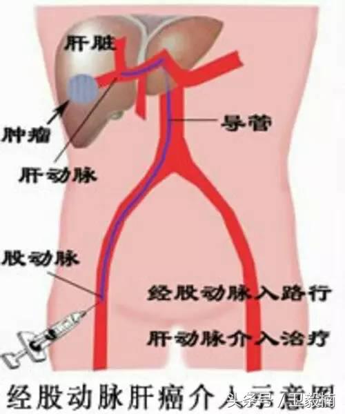 微创介入科一卫毅楠,什么是心血管介入治疗