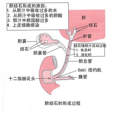 这就是肝脏结石！看完是不是觉得挺恐怖的？