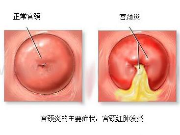 60岁女人有妇科炎症的表现,妇科炎症科普知识