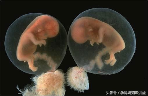 怀孕41天有鲜红血正常吗,孕早期出血孕囊旁有液性暗区