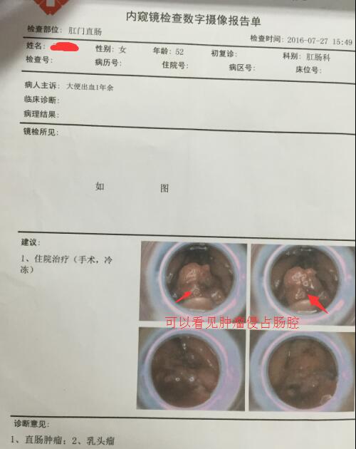 低位直肠癌保肛冷冻治疗多少费用,低位直肠癌患者保肛后存活率