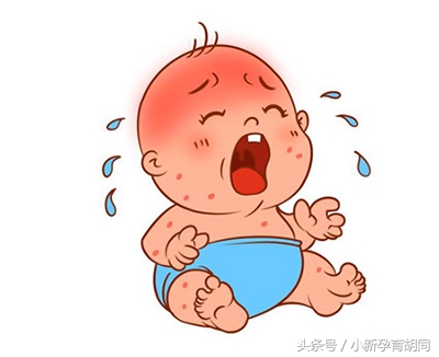 宝宝头上有湿疹,宝宝脸上的湿疹