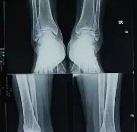 谁知道结核性胸膜炎,肺上有结核病灶就一定是肺结核吗