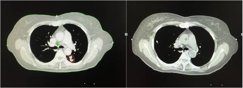 晚期肿瘤治疗最新疗法,肿瘤治疗新利器