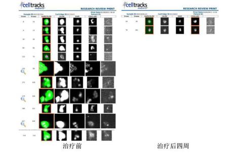 肿瘤光动力,肿瘤生物细胞治疗法