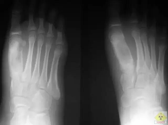 谁知道结核性胸膜炎,肺上有结核病灶就一定是肺结核吗