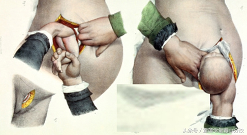 为什么剖腹产的孩子会感统失调,为什么剖腹产的孩子容易感统失调