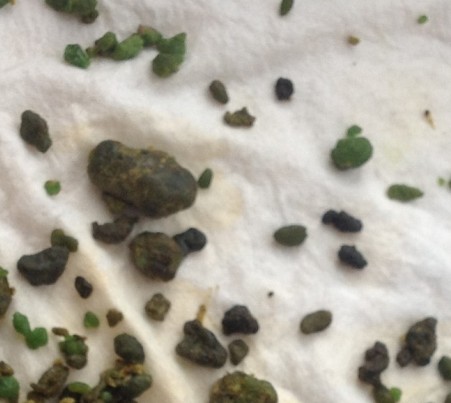 这就是肝脏结石！看完是不是觉得挺恐怖的？