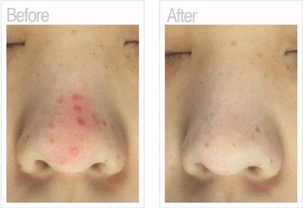 下巴和鼻子周围长痘痘,为什么鼻子周围红红的长痘痘痒