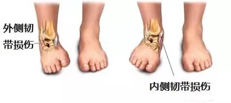 踝关节放血针刺什么部位,踝关节扭伤刺血疗法