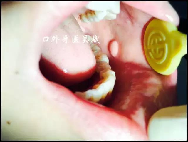 嘴里长疱怎么回事,嘴里起了好几个水泡怎么回事