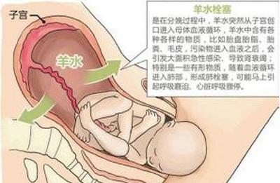 生产时咳嗽会导致羊水栓塞吗,生产后胸闷是羊水栓塞吗