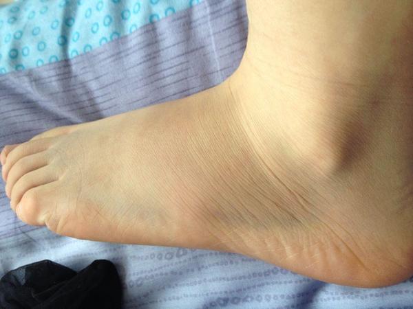 皮层基底节变性该怎么治疗？