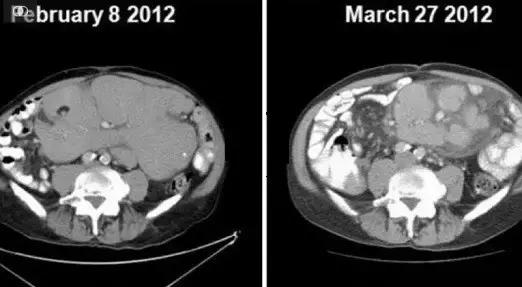 澳华裔科学家攻克白血病！新药获批即将上市或为医保廉价药！