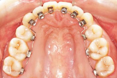 牙齿难看怎么矫正,牙齿丑不拉几怎么在家解决