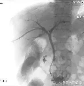 微创介入科一卫毅楠,什么是心血管介入治疗