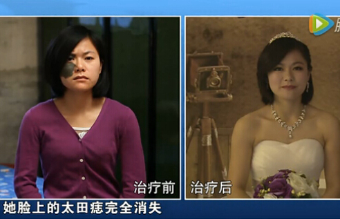 胎记拍婚纱照,肩膀有胎记怎么拍婚纱照