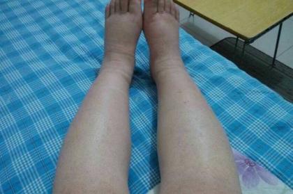 孕妇小腿浮肿怎么解决,孕妇小腿浮肿怎么回事