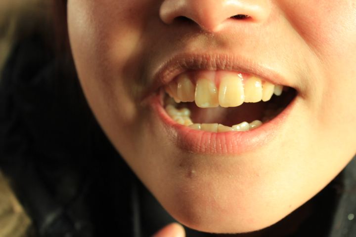 牙齿前突嘴巴闭不紧面相,牙齿前凸不整牙怎么办