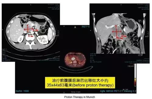 中国的质子中心有几家,全国有几所质子医院哪所最好