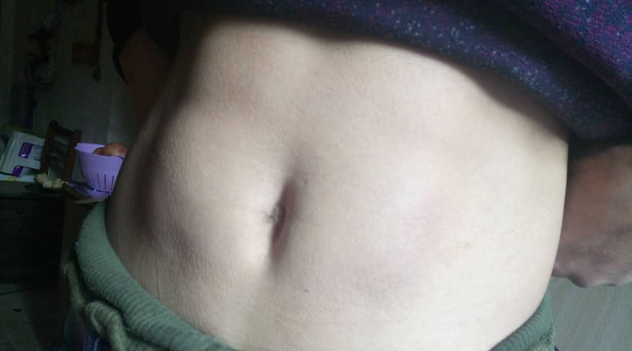 糖友身上有针刺感有什么办法呢,打胰岛素皮下硬结怎么处理