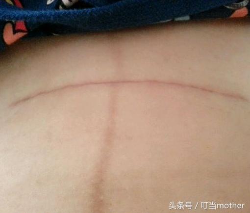剖腹产9个月后又怀孕了怎么办,剖腹产9个月又怀孕怎么办