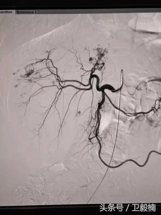 微创介入科一卫毅楠,什么是心血管介入治疗