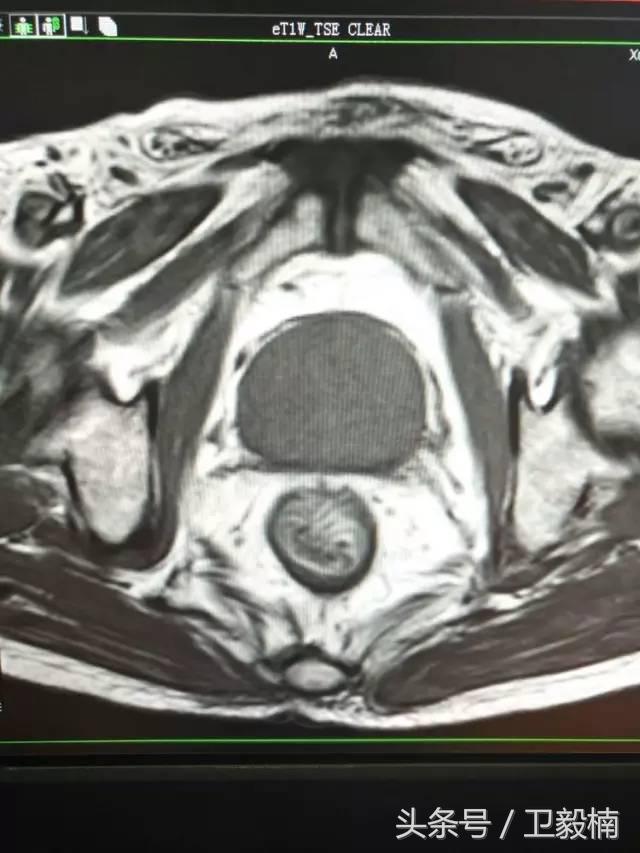 微创介入科一卫毅楠,什么是心血管介入治疗