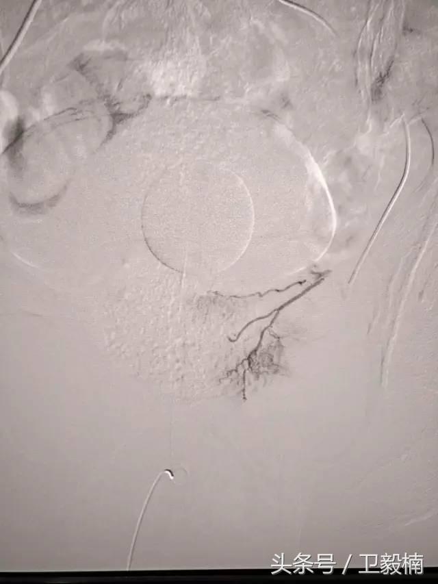 微创介入科一卫毅楠,什么是心血管介入治疗