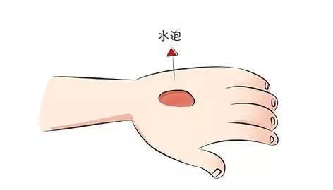 中药热敷局部对白癜风有疗效吗,治疗白斑的中药可以泡脚吗