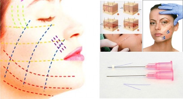 埋蛋白线要多少钱,蛋白埋线提升可以保持多久
