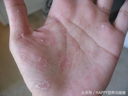 冬天手出汗然后脱皮怎么回事,一到冬天手就严重脱皮用什么药