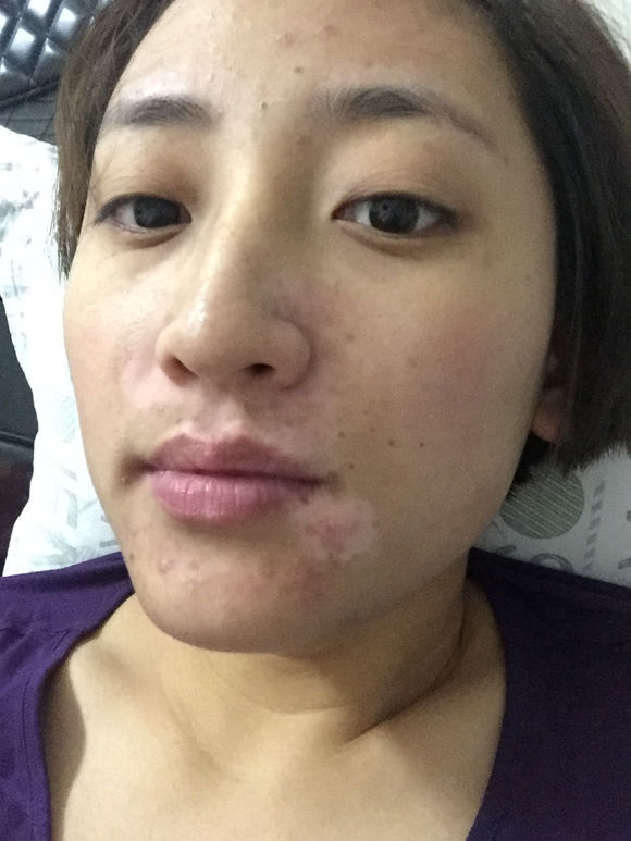 白斑光照,白斑光照后图片