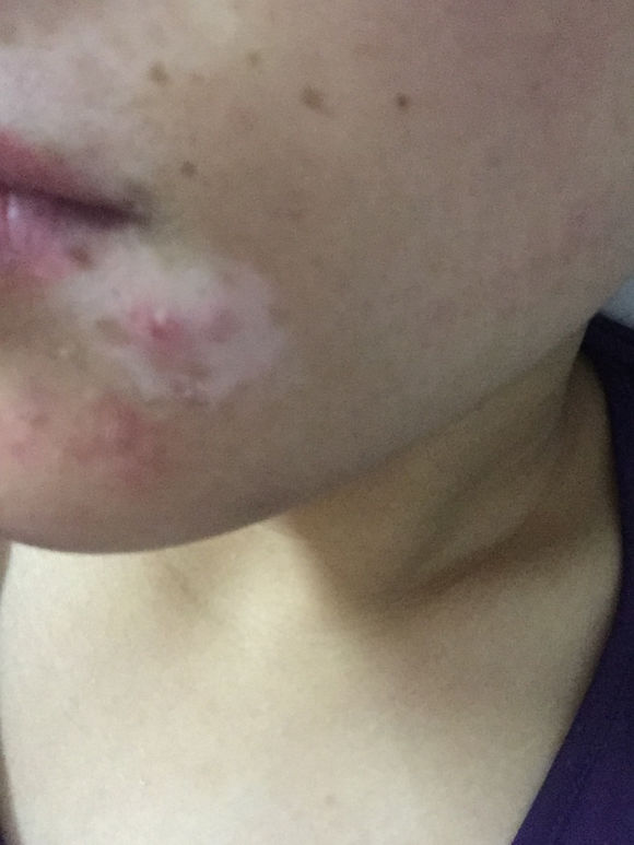 白斑光照,白斑光照后图片