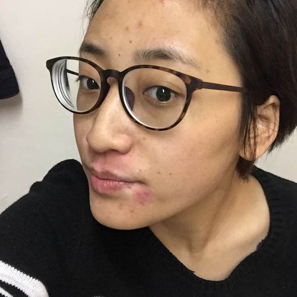 白斑光照,白斑光照后图片