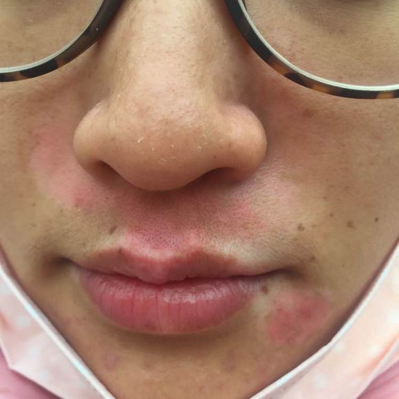 白斑光照,白斑光照后图片