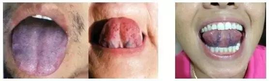 舌苔辨证图谱望舌识病,揭秘舌苔图谱轻松自诊