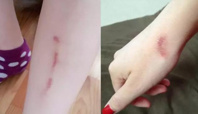 祛疤修复精华组合 (有效祛疤小妙招不妨你也来试一下)