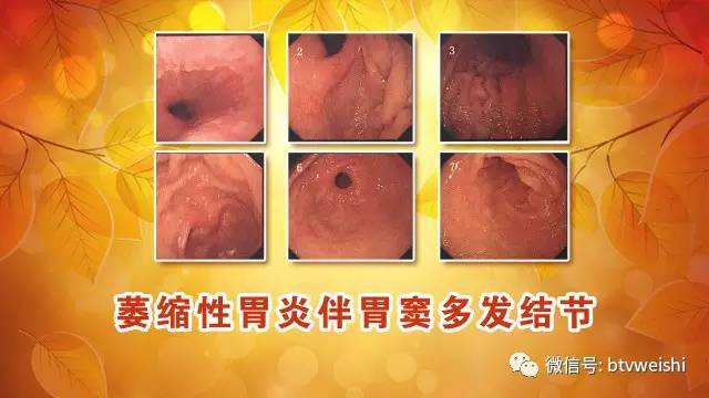 「养生堂」今日17:25播出：《消化重症的“逆转术”》