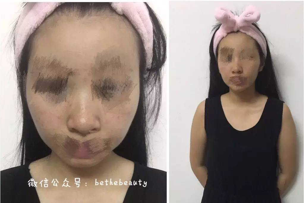 鼻子除了整容变挺还有什么办法,不想整容怎么让鼻子好看