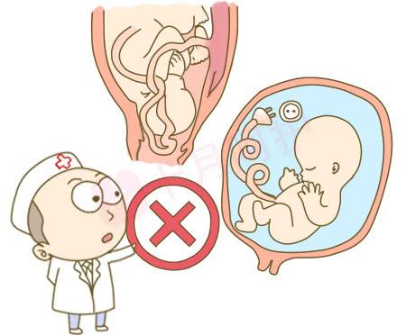 “脐带脱垂”来了!麻醉科的你准备好了吗?