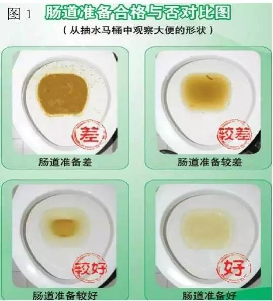 肠镜肠道准备标准,肠道准备一般会漏掉肠癌吗