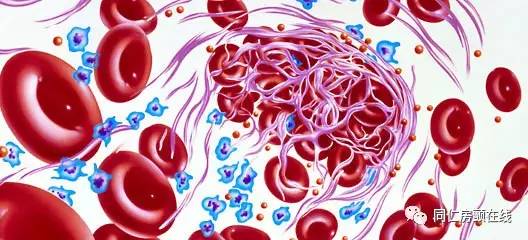 房颤射频消融术风险高吗,房颤导管射频消融手术的利弊