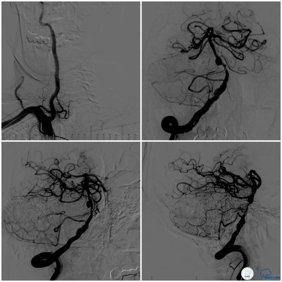 天坛周记｜基底动脉狭窄合并动脉瘤血管内介入治疗一例