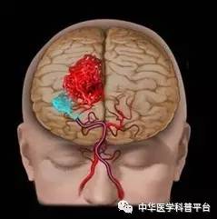 牙龈自发出血是什么病的前兆,自发出血是什么意思