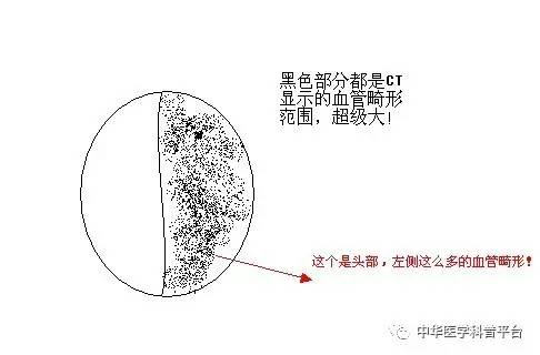 牙龈自发出血是什么病的前兆,自发出血是什么意思