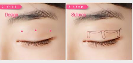 割双眼皮选医生真实经验分享,割双眼皮不能不知道的7个潜规则