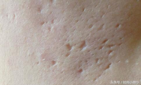 脸上30年凹凸疤痕怎么去除,脸上像月球表面怎么修复