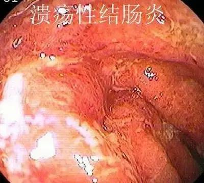 溃疡性结肠炎治疗有哪些偏方,溃疡性结肠炎治疗有哪些偏方呢